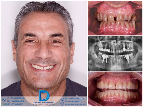 Caso de transformación dental 2 – Dental Modena